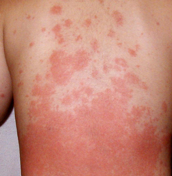 Shingles | About | Herpes Zoster | CDC