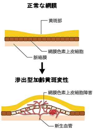 滲出型加齢黄斑変性の概略イラスト