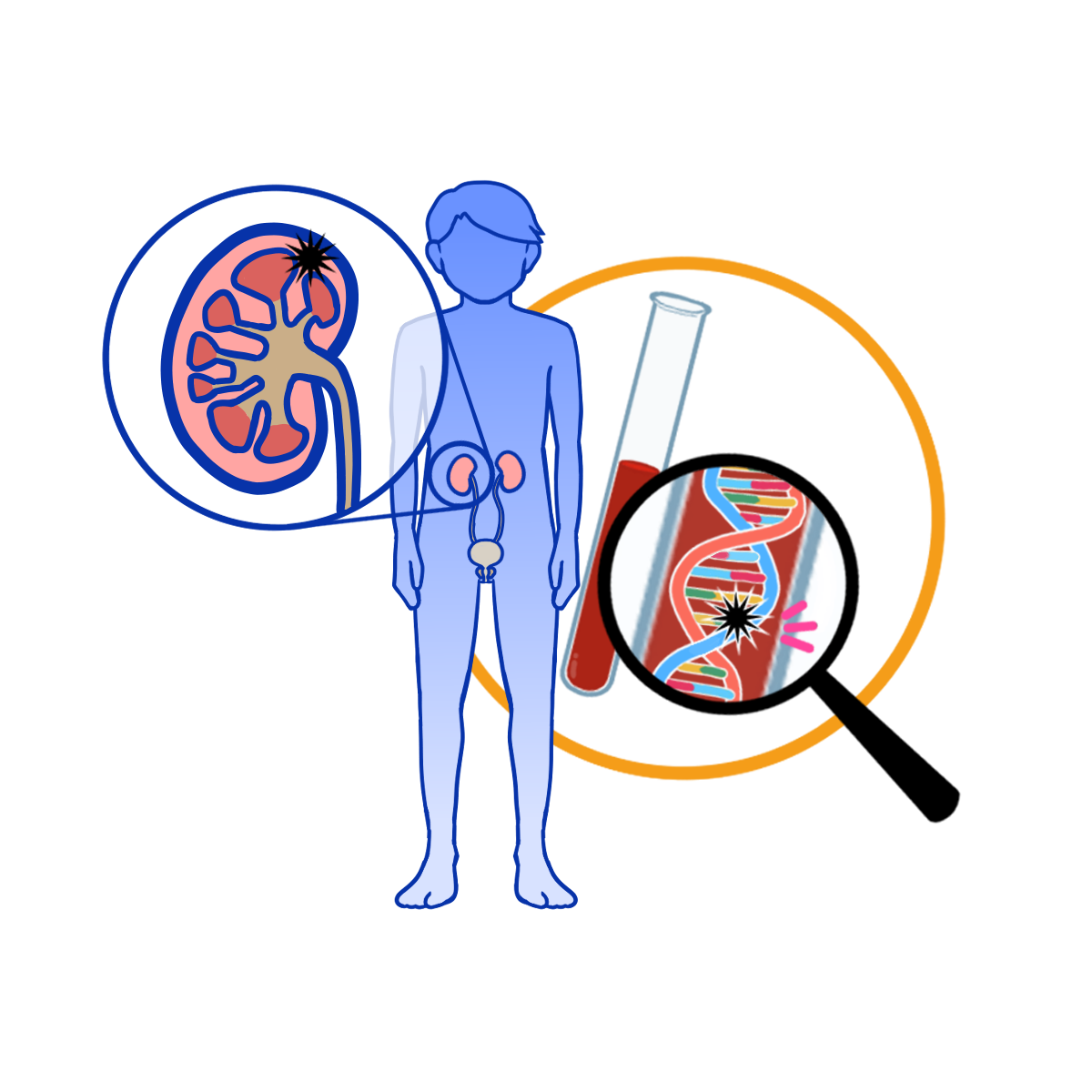 腎がん解析イメージイラスト